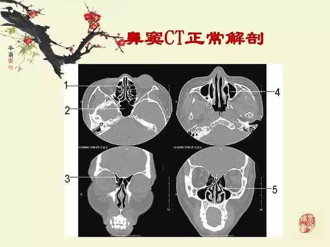 鼻鼻窦炎的影像学表现
