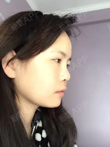 从小鼻子就特别塌,属于完全没有鼻梁类型的,没有鼻尖_圈子-新氧美容