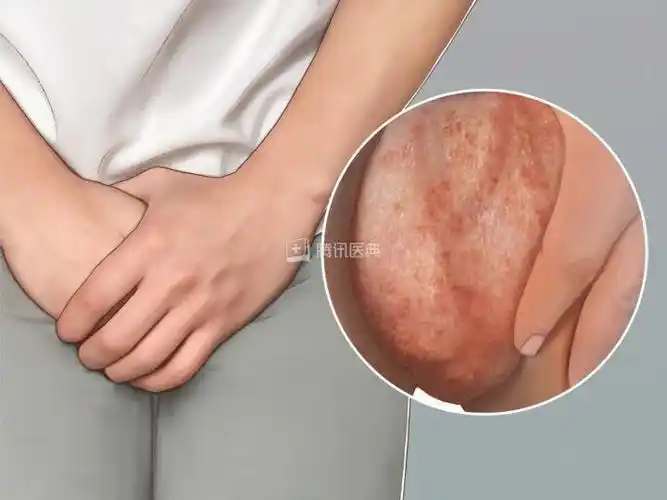 绣球风是指阴囊疡痒发红,或皮上生赤粟样疙瘩,抓破脂水浸淫,或有灼热