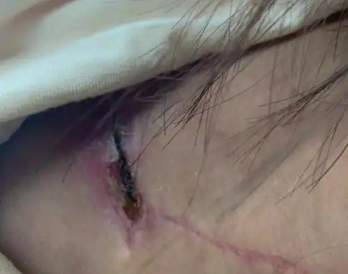 徐冬冬深夜晒脂肪瘤术后照,伤口长达五六厘米,发文感慨演员不易