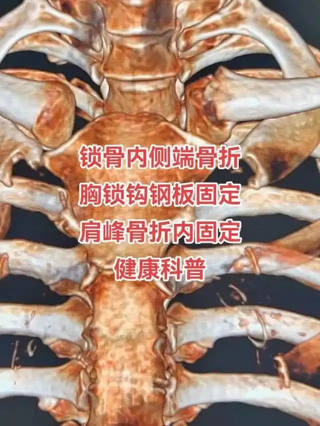 锁骨内侧端骨折 胸锁钩钢板固定 肩峰骨折内固定 健康科普 # - 抖音