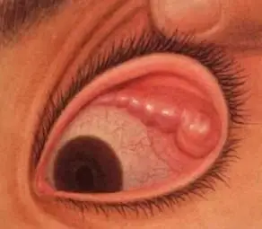 治疗泪腺炎从四方面着手