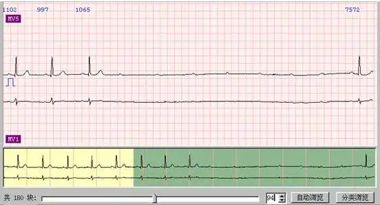 常出现逸搏,形成不完全性房室分离,两者的鉴别要注意心室夺获的间期