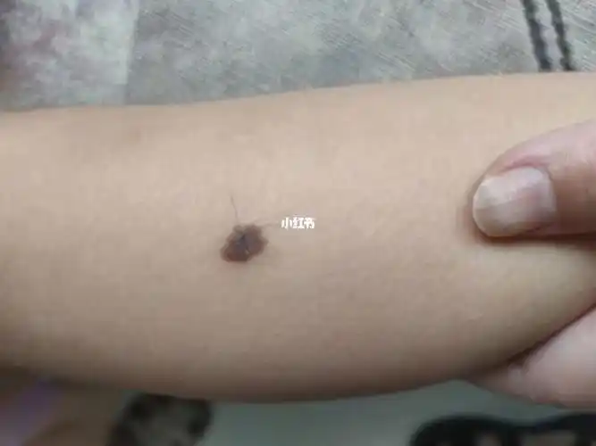 我女儿刚出生腿上就一个小黑点,随着年龄长大它也跟着长,6岁了现在