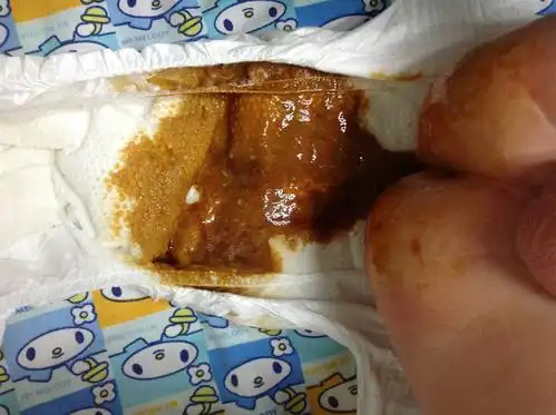 宝宝深褐色大便正常嘛