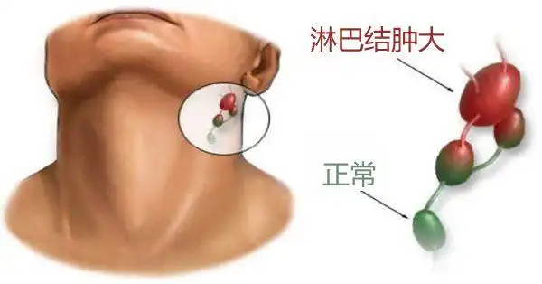 科普颈部淋巴结肿大如何检查