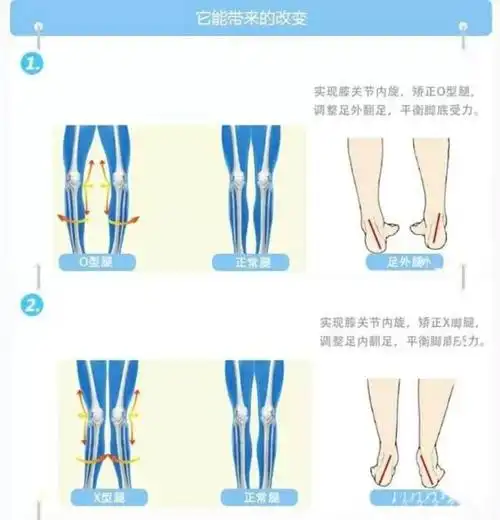 一些人的腿是直的而另一些人却是弯的是什么原因导致的