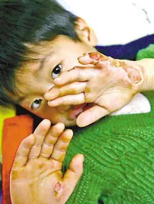 被万伏高压电击倒七岁男孩奇迹生还