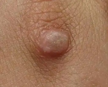 主要因为患者免疫力差的同时又接触到叫做人类乳头瘤病毒的痘类病毒