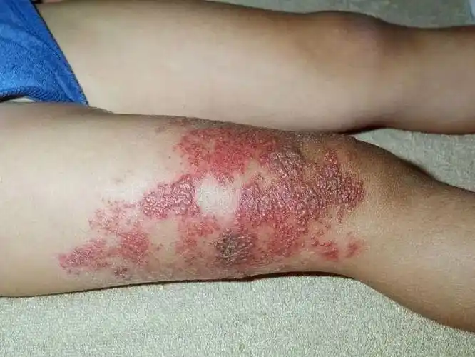 国外数据显示,17岁及以下儿童的带状疱疹粗发病率为74/10万人年.