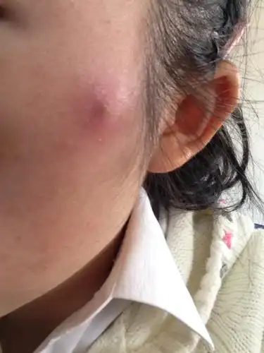 脸上长个大包 很疼 鼓起来还扯着皮肤的 左脸疼了一天了.