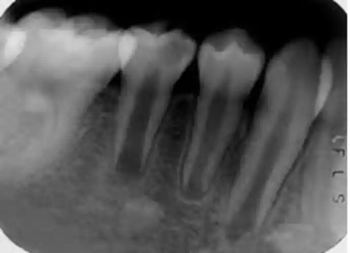 年轻恒牙一般指萌出不久的恒牙,尚处于发育阶段,在形态和结构上都尚未