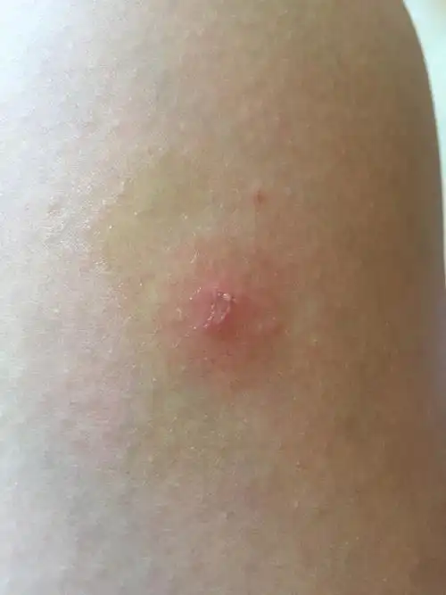 大腿突然出现 按压会痛还会痒 起泡里面白白的