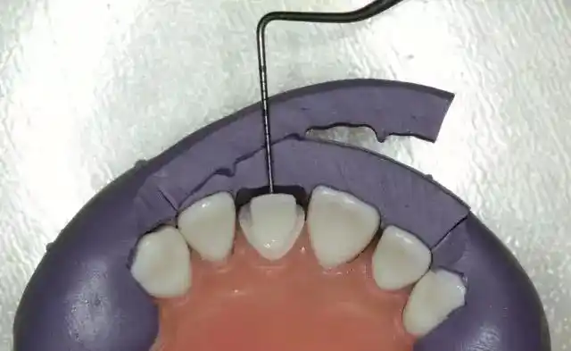 硅橡胶导板牙体预备六大步骤详解