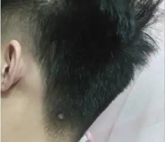 后脑勺长痣的人的运程后脑勺有痣代表什么