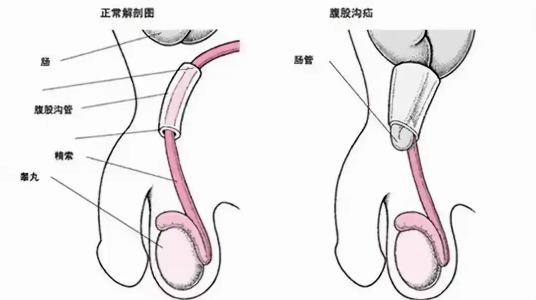 狐疝,相当于西医学的腹股沟斜疝,以婴儿和中,老年男子较多