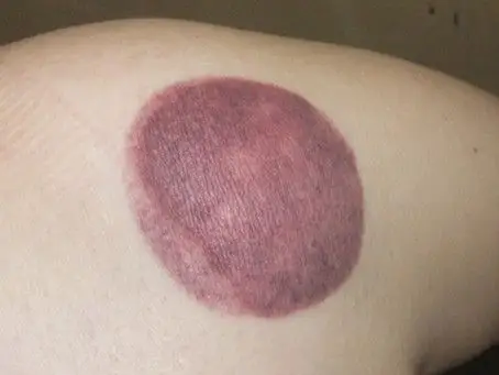 刮痧拔火罐后的颜色表示什么?(有图片)