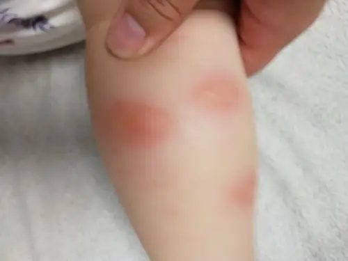 14 21:09                              宝宝的这个不太像蚊子叮咬的