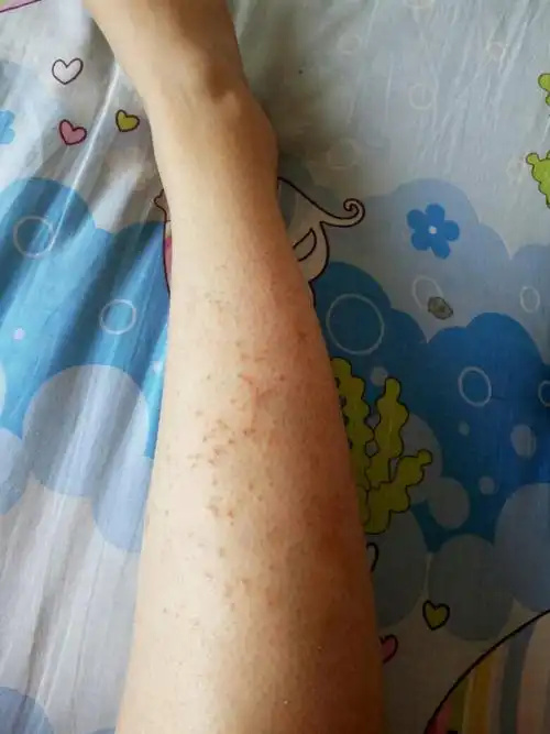 用了湿疹要也不管用,白天能好一点,晚上更严重