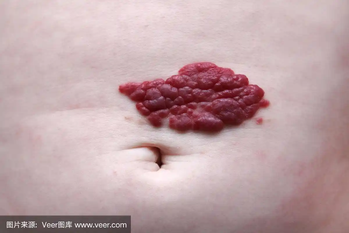 胎儿腹部毛细血管瘤红色胎记