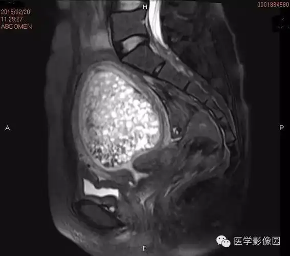 【重温经典 】完全性葡萄胎