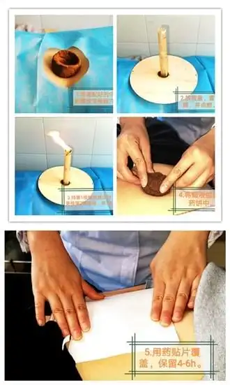 汤阴县中西医结合医院中医特色疗法之脐火疗法技术
