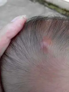 婴幼儿头上长出像青春痘一样的包是怎么回事头上长出这么一个包包是