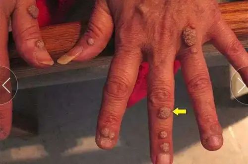 常见,所导致的皮肤相关临床表现也多种多样,如上图箭头所示的寻常疣