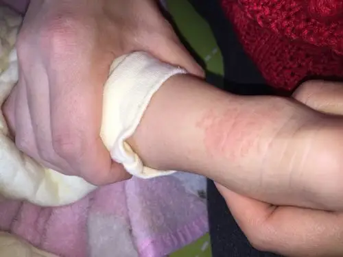 宝宝脚后跟长了一片这样的疹子,另外一只脚也有,只是不成片.