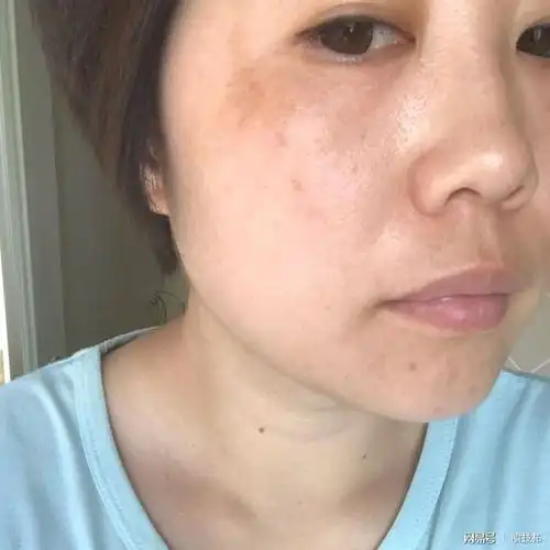 皮肤的头号杀手黄褐斑怎样祛黄褐斑