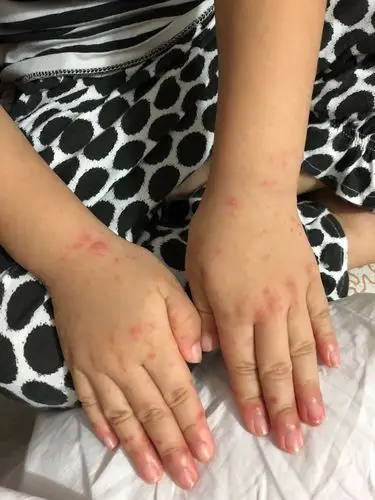 门诊看手足口个疱疹性咽峡炎你遇到了哪些坑