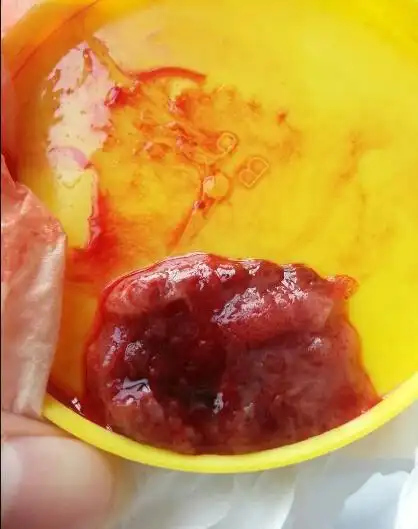 药流后流出来的残留应该是什么样的