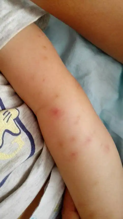 宝宝手臂上起这种红点是怎么回事两只手都有