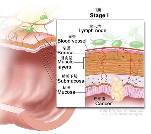 iia期:癌症已经通过结肠壁的肌肉层扩散到结肠壁的浆膜层(最外层).