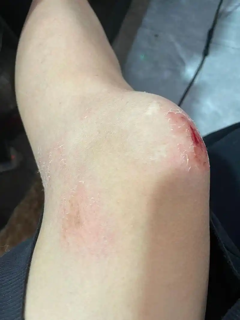 骑车开车这么多年第一次事故,主要人家还没碰到我,人家一个猝不及防