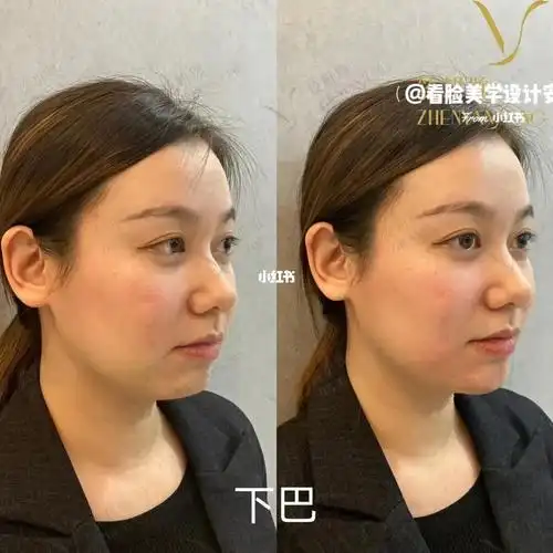 短下巴下巴后缩显瘦十斤的调整方案