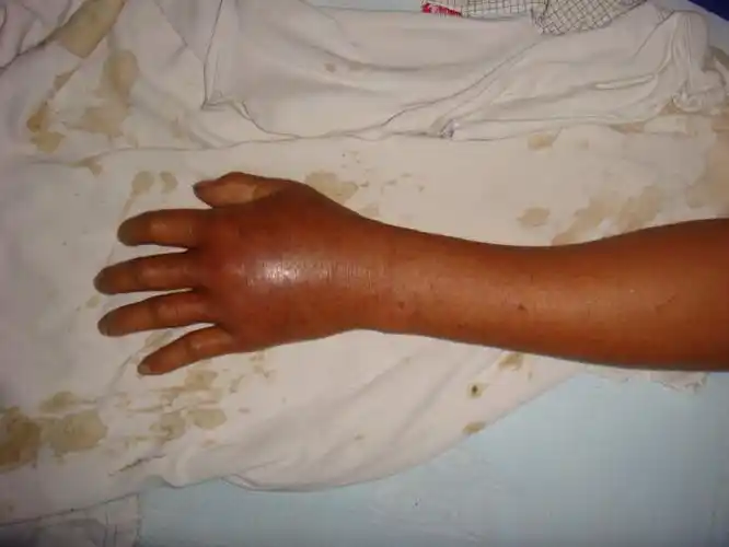 夏季草丛"杀手"——蛇咬伤