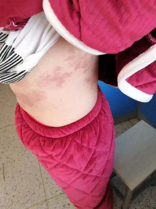 带状疱疹治疗病例 - 好大夫在线