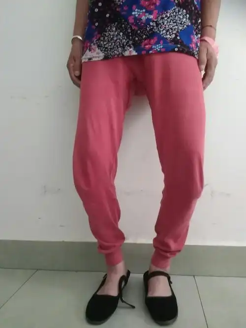 重度"o"形腿术前:双膝骨关节炎,严重膝内翻术前外观像