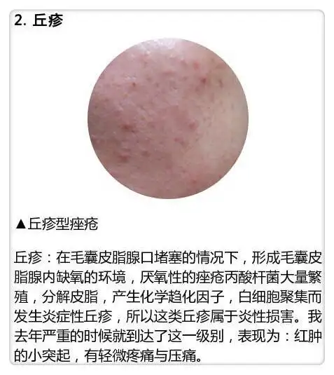 白头粉刺怎么去