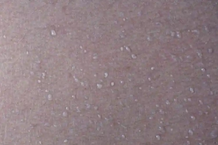 白痱的水疱图白痱皮肤结痂图病因痱子结痂的发生不止有皮损中的浆液