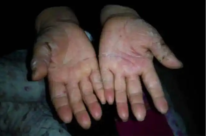 为什么得鹅掌风? 4个因素来分析