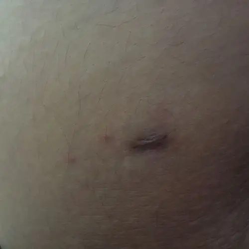 我脚上皮肤上一个洞好久了,是不是什么虫子钻进去了