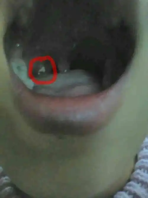 喉咙扁桃体旁边起了个乳白色米粒状的东西,不痛不痒,有异物感,有三四