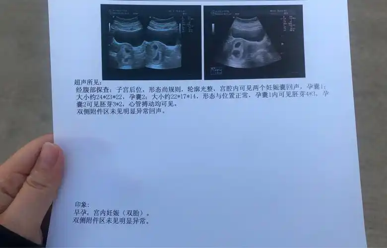 第一次b超检查结果出来啦,是双胎,好开心啊,医生说看单子一切正常