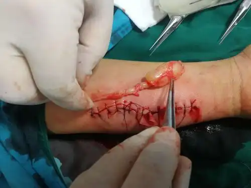 前臂神经纤维瘤