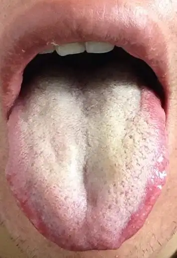 请看一下这个舌苔 很白是什么问题?