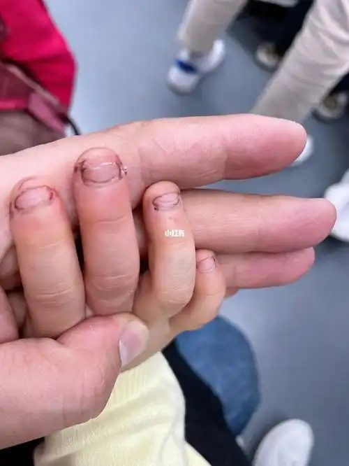 小孩抠手指指甲皮