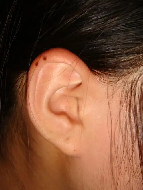 西安鹏爱耳垂再造整形手术的优势