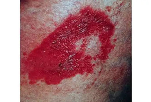 炎症性疾病,常见于小腿伸侧,临床表现为红色或紫红色疼痛性炎性结节